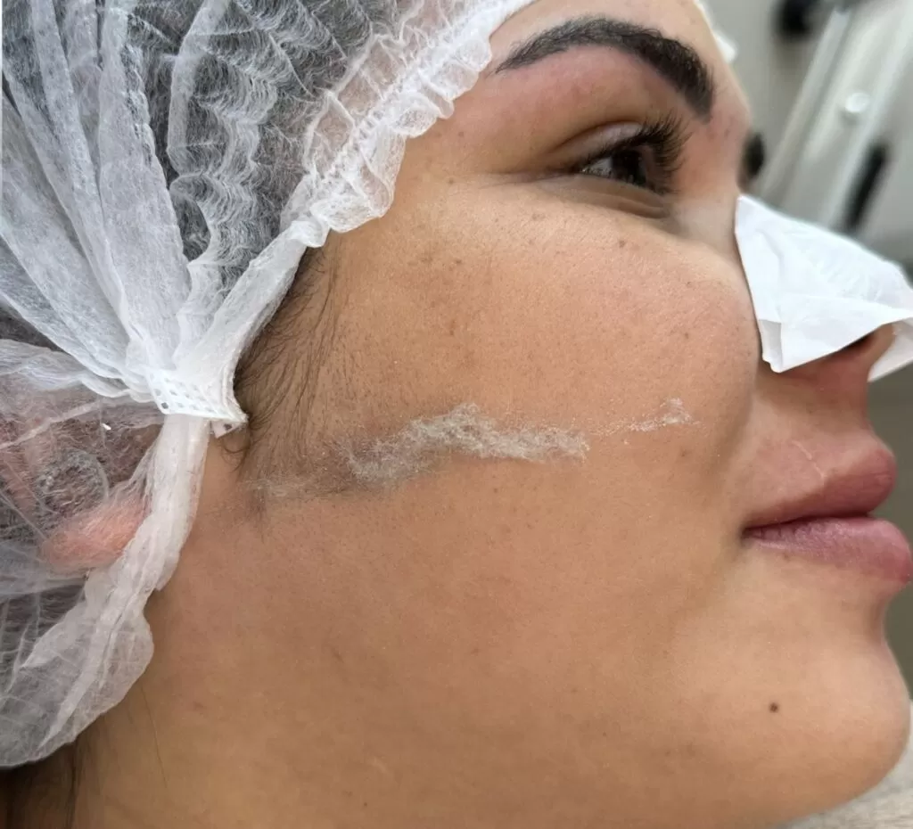 Dermaplaning 1 Dermaplaning 1