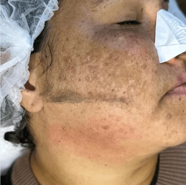 Dermaplaning Dermaplaning