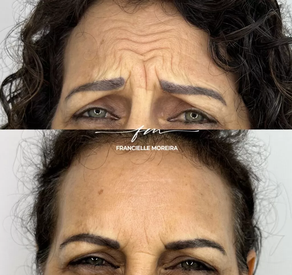 botox 1 botox 1