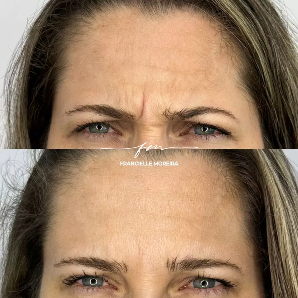 botox 2 botox 2