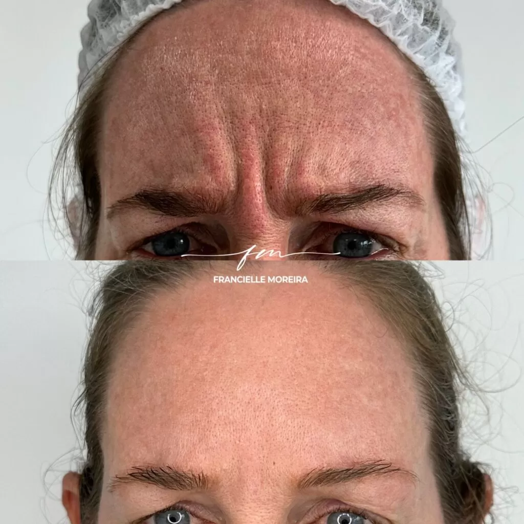 botox 3 botox 3