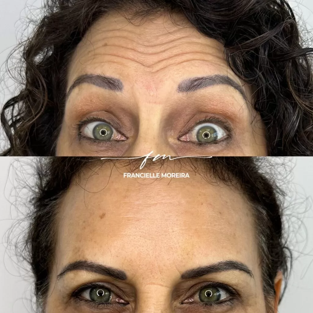 botox 4 botox 4