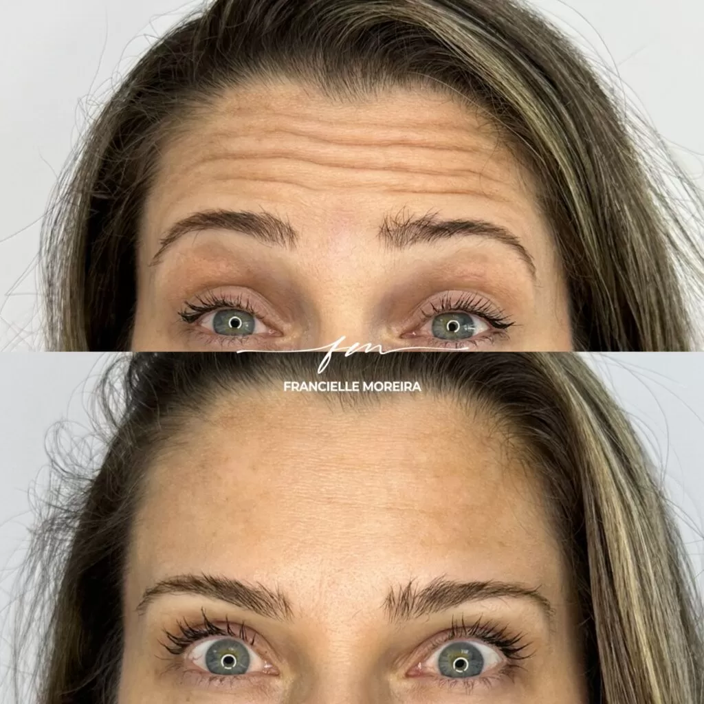 botox 5 botox 5