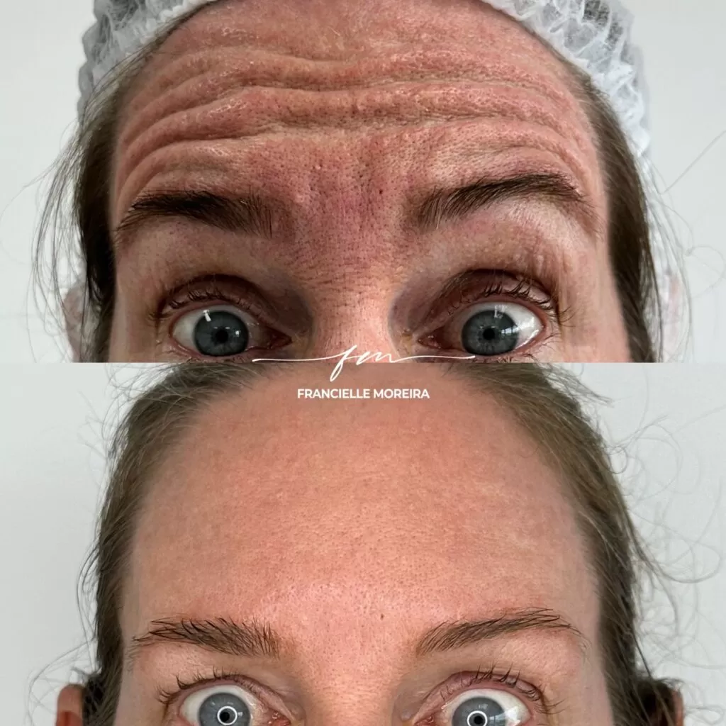 botox 6 botox 6